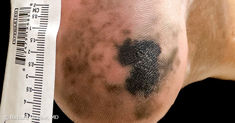 Acral lentiginous melanoma on heel of foot