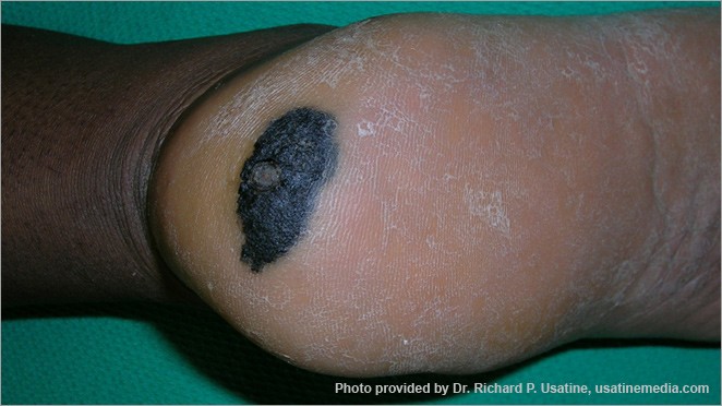 Acral lentiginous melanoma on heel