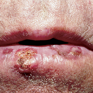 aktinische Cheilitis