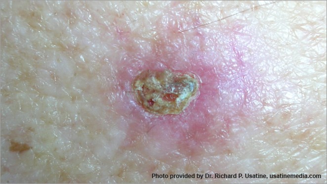 Basal cell carcinoma – a sore that does not heal