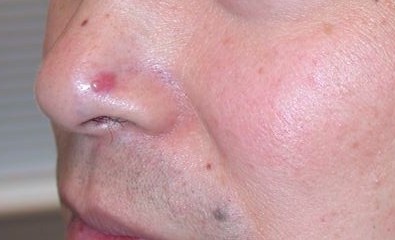BCC on the nose of an Asian man