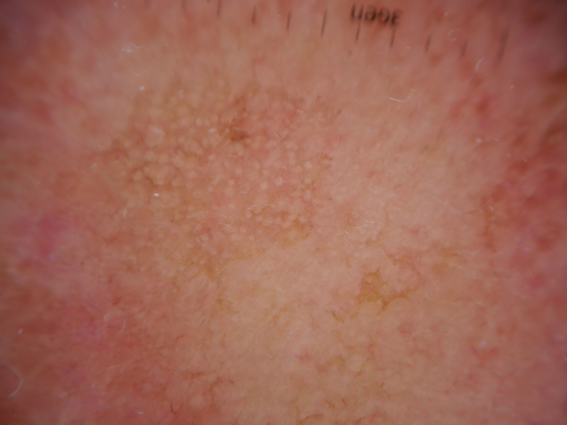 Close up of actinic keratoses on scalp.