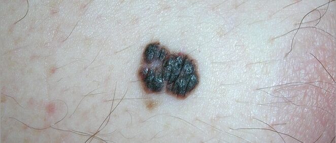Dark, raised melanoma with irregular borders