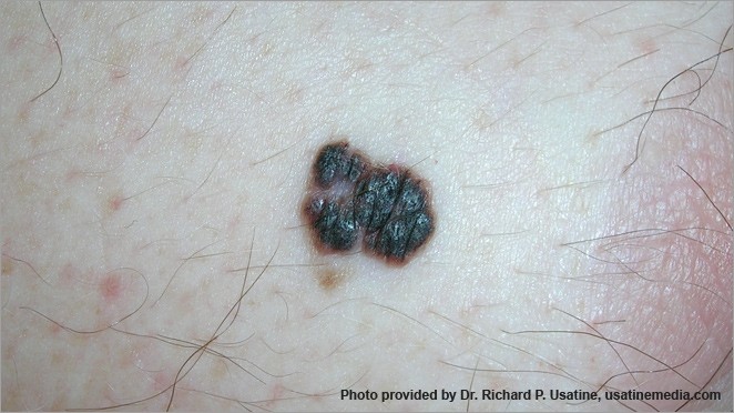 Dark, raised melanoma with irregular borders