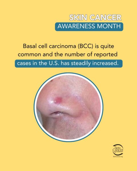 Skin cancer awareness month poster with an image of basal cell carcinoma on a nose.