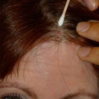 Hautkrebsläsion entfernt