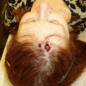 Operation zur Entfernung von Hautkrebs