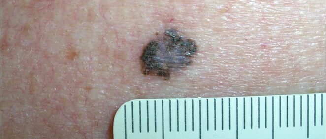 Large melanoma with irregular borders