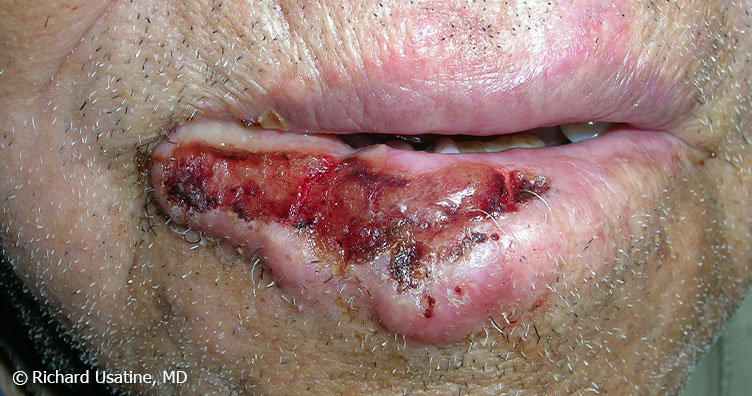 Large squamous cell carcinoma on lip