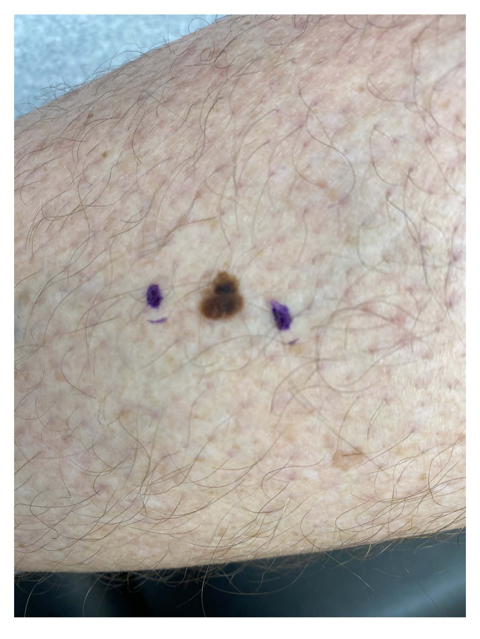 melanoma in situ 1 cm on the right calf
