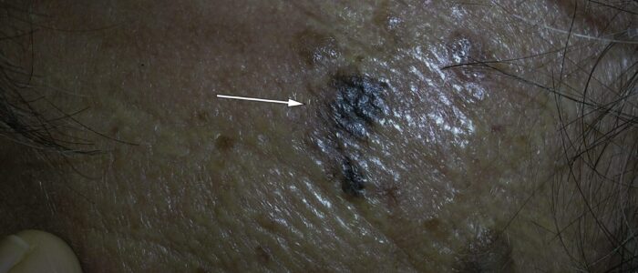 Melanoma, irregular borders