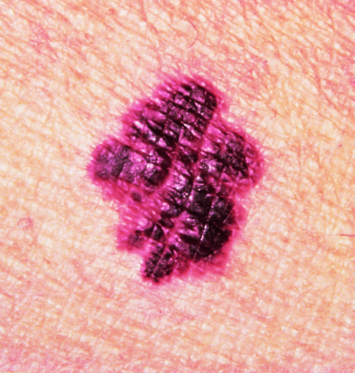 melanoma-irregular borders