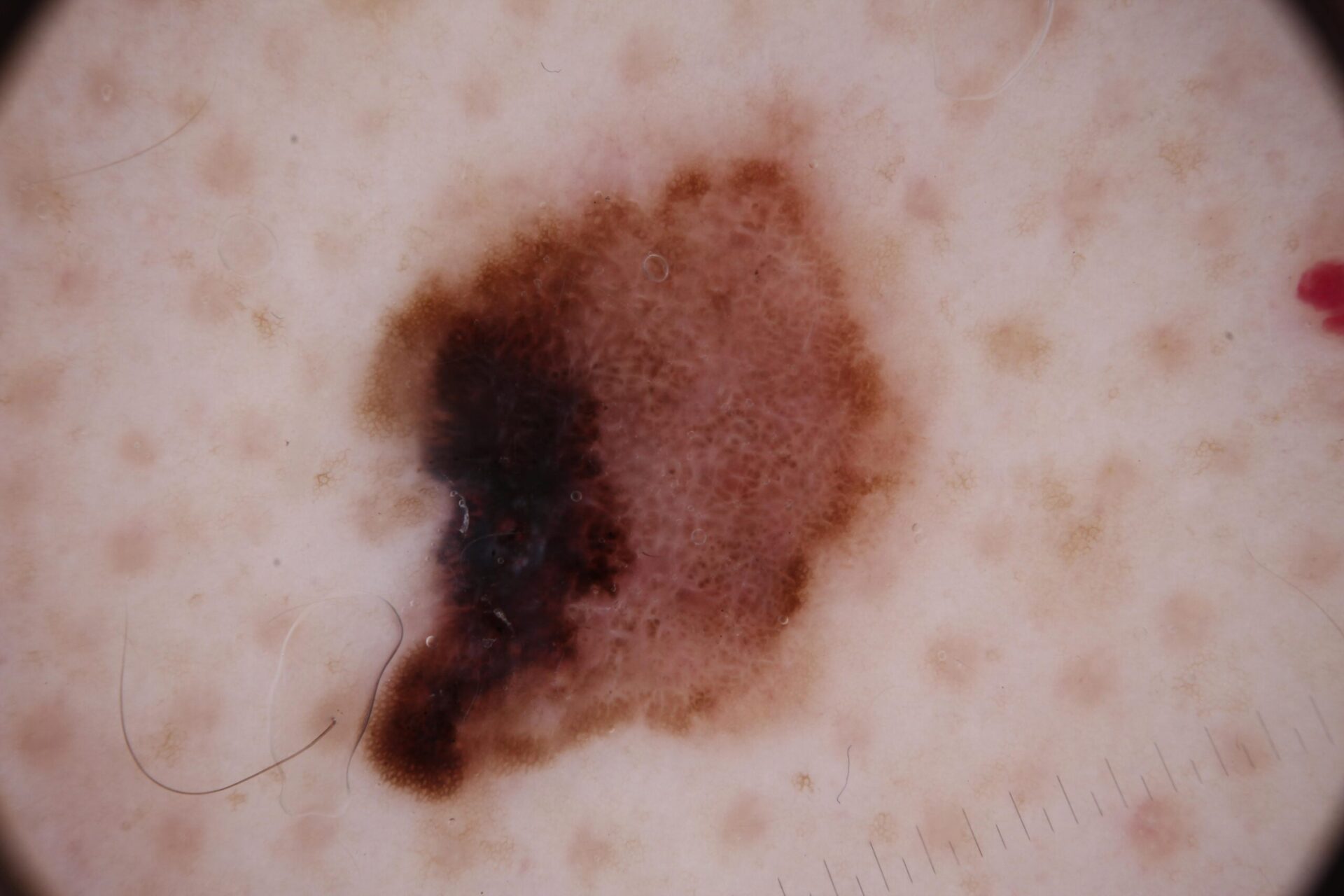 Melanoma1