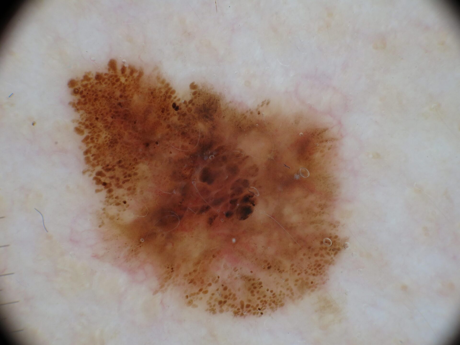 Melanoma3