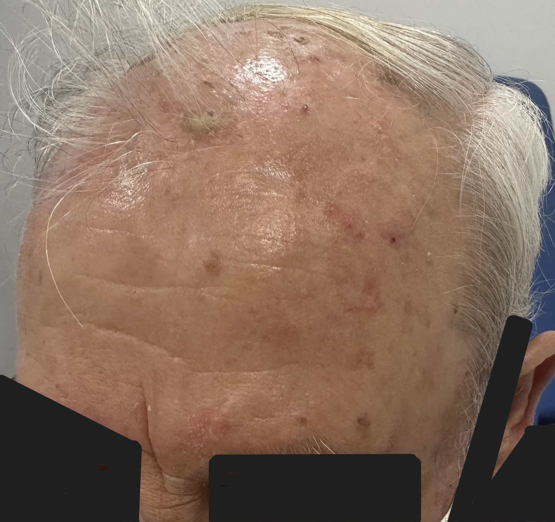 Multiple actinic keratoses on scalp
