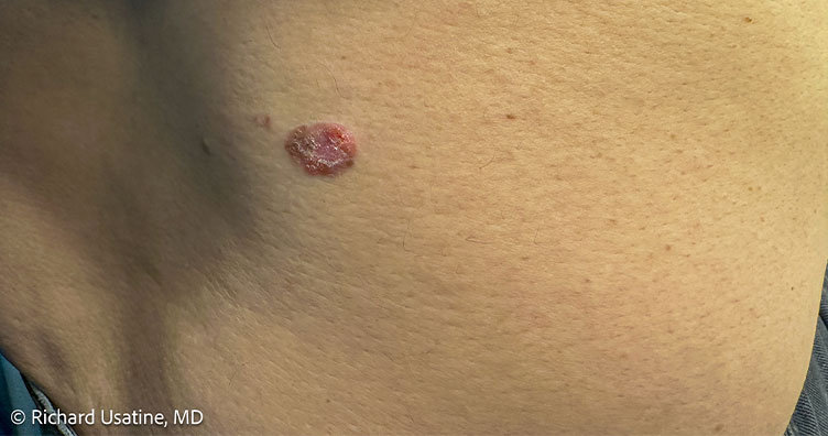 Raised, reddish squamous cell carcinoma