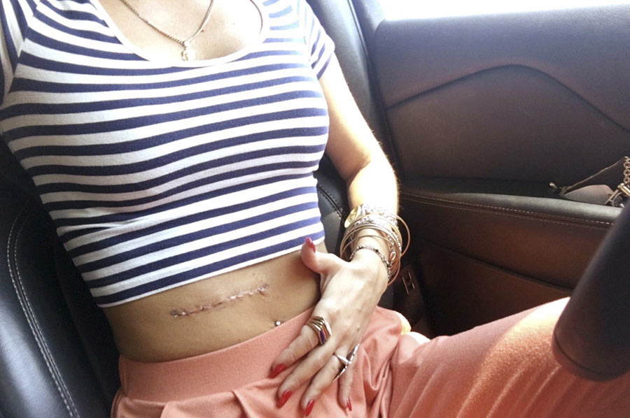 Cicatriz de melanoma en el abdomen