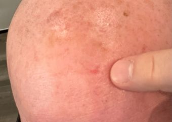 Plattenepithelkarzinom auf der Stirn, auf das Ron hingewiesen hat