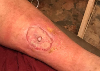 post intervento di innesto cutaneo