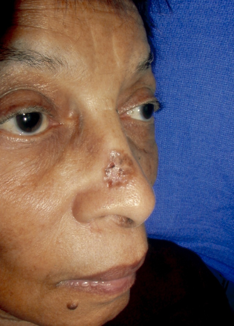 Slide 61 – Morpheaform BCC face Black female Gloster