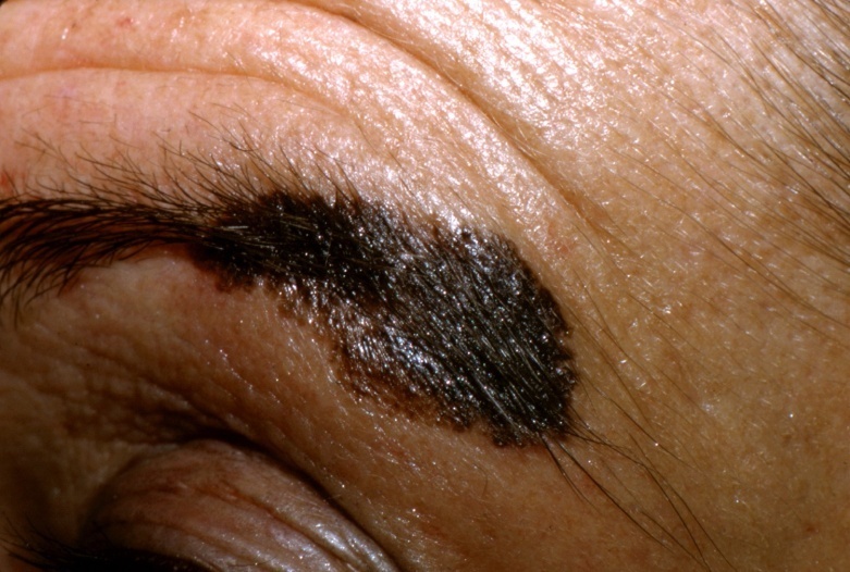 Slide 81 – Melanoma eyebrow Hispanic male Steven Padilla MD