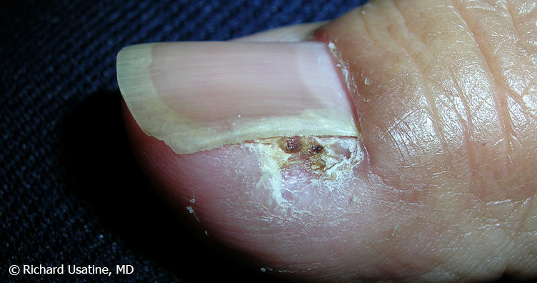 Squamous cell carcinoma beside toenail