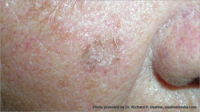 Squamous cell carcinoma, scaly patch on cheek