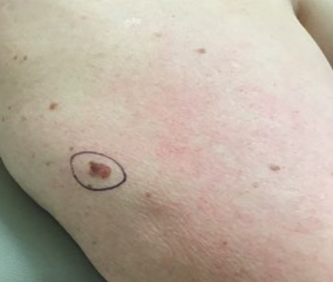 Superficial melanoma 0.55mm Upper Arm Courtesy EK Hale 1.25.22