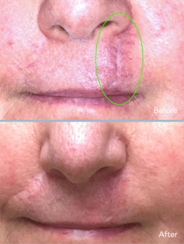 Kombination aus Dermabrasion und CO2-Laser zur Behandlung von Narben